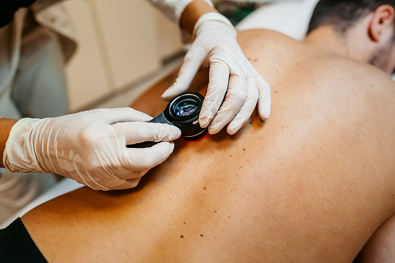 Ein Mann lässt sich beim Hautarzt seine Muttermale auf dem Rücken kontrollieren.